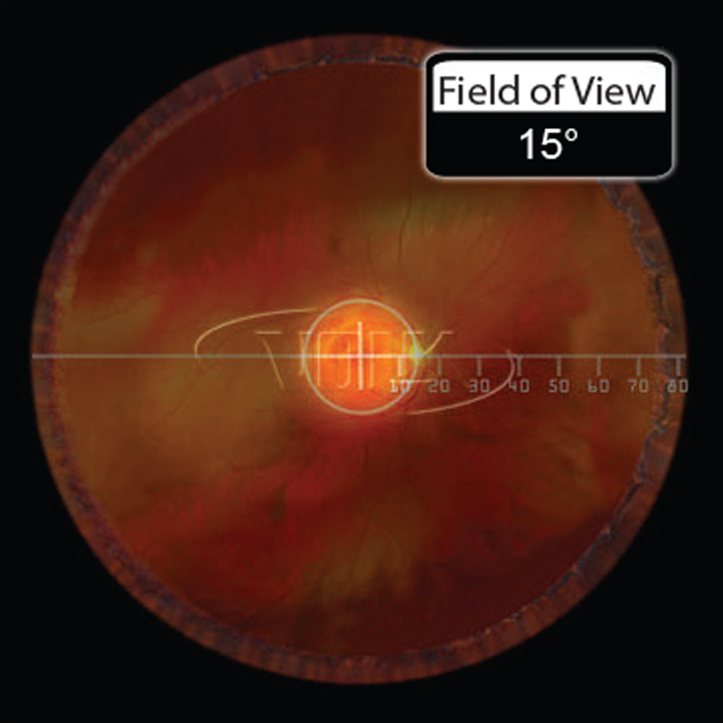 Lente Volk Fundus High Mag SSV Vitrectomia