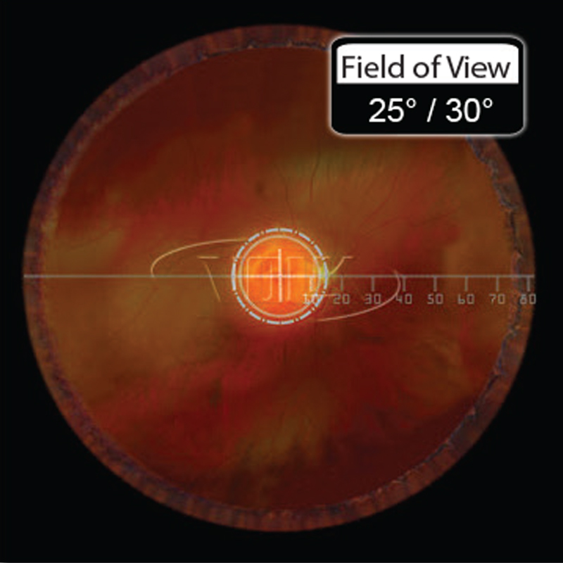 Lente Volk Laser Fundus 20mm