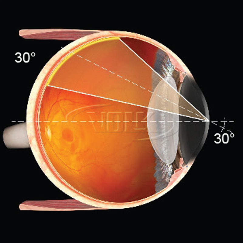 Lente Volk Prism 30°SSV Vitrectomia