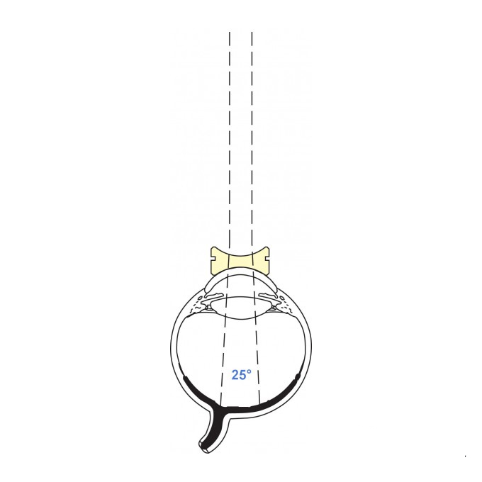 Lente pediatrica biconcava 92D Vitrectomia