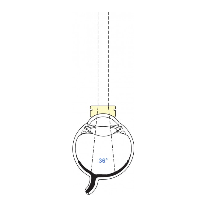 Lente pediatrica piatta Vitrectomia