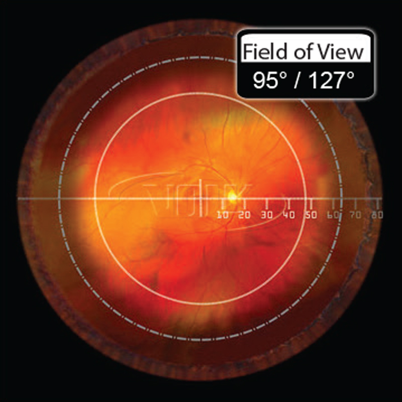 Lente per vitrectomia 156 DynaView