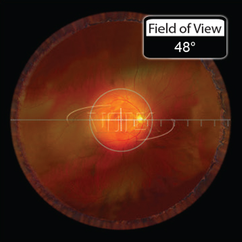 Lenti Volk Wide Field