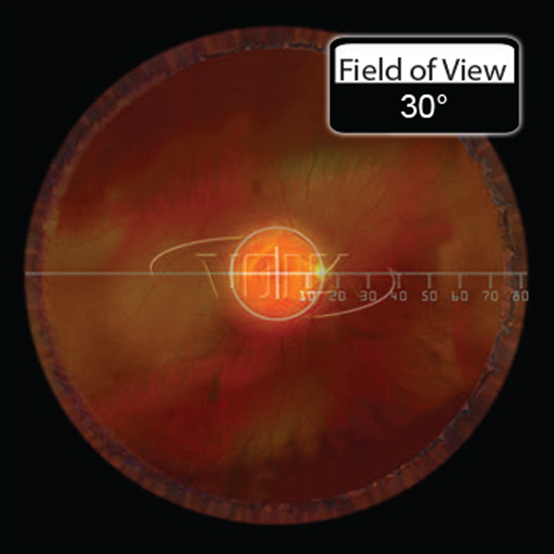 Lenti Volk ingrandenti Central Retina