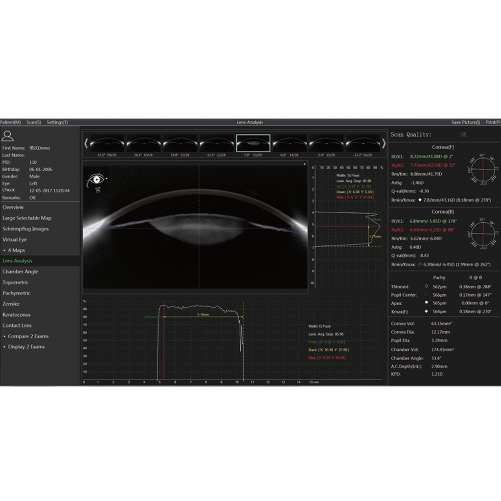 Topografo/Scheimpflug Scansys